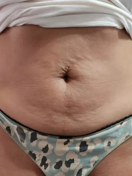 Antes — abdomen, de frente