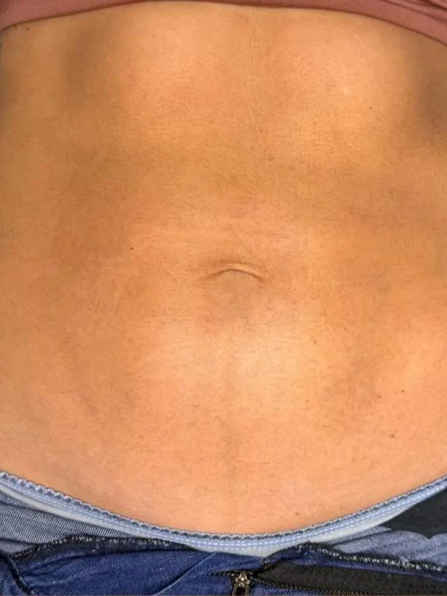 Antes — abdomen, de frente